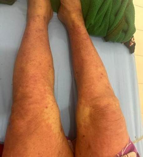 A person's legs with a green towel
AI-generated content may be incorrect.